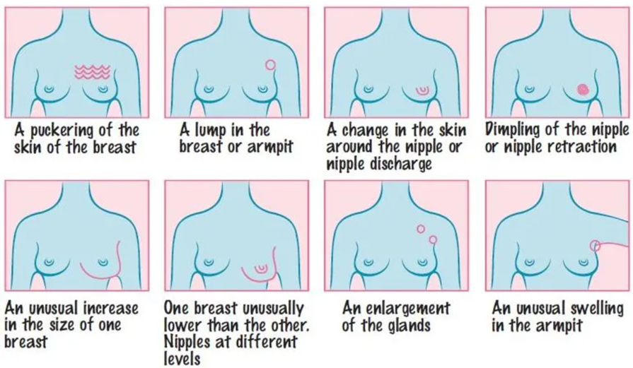 Warning signs of breast cancer